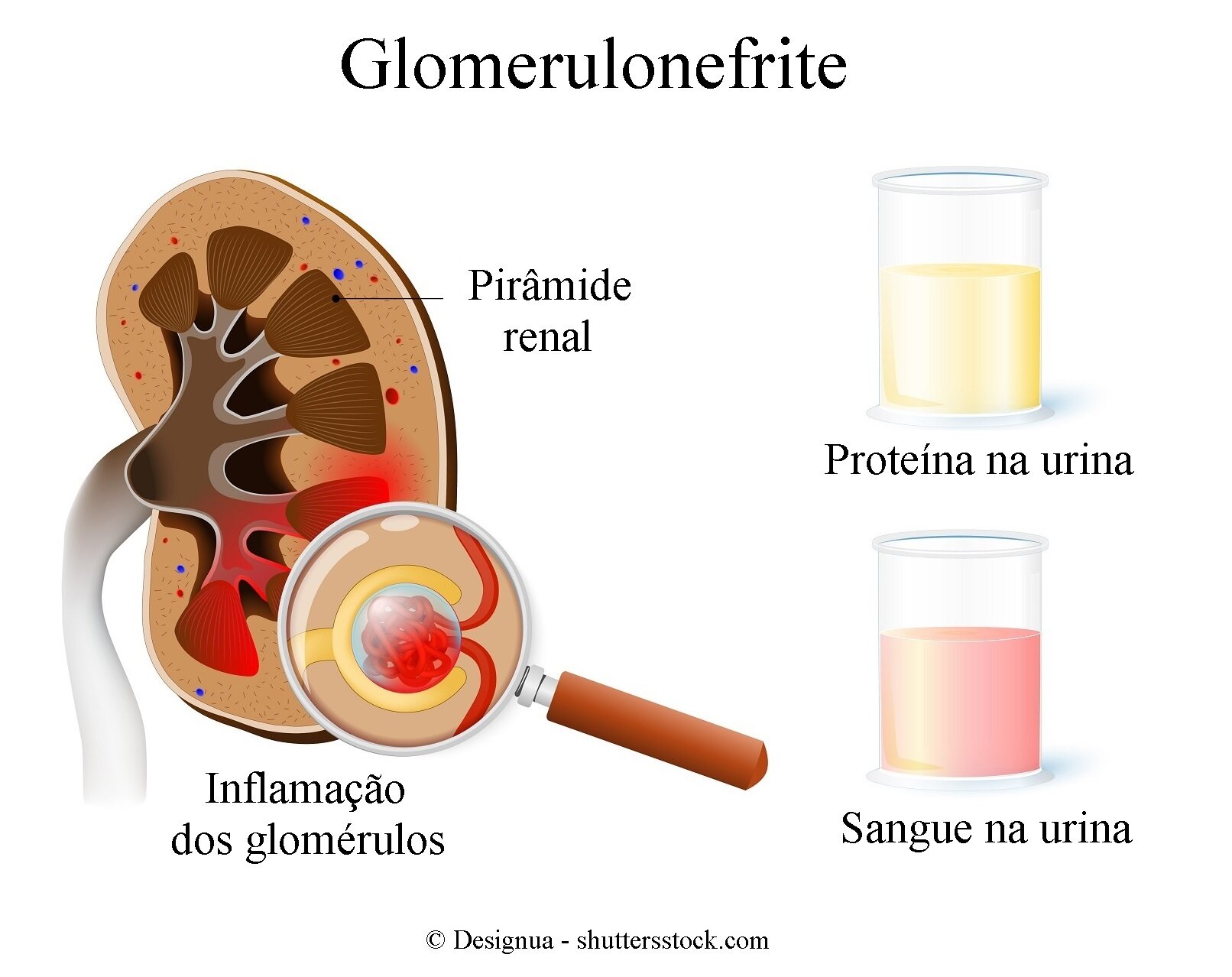  Glomerulonefrite você sabe o que é? Fique atento!