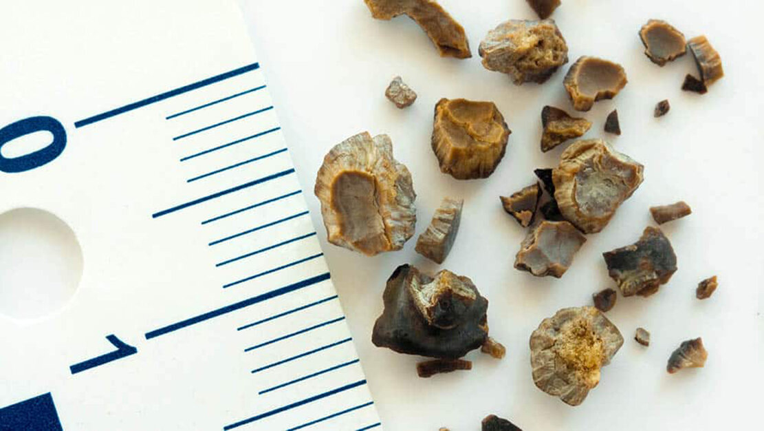 Cálculo renal: como saber se eu tenho pedra nos rins?